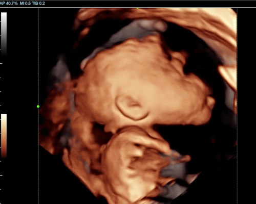 Bonding Scan and Heartbeat Bear Bundle Near Huddersfield