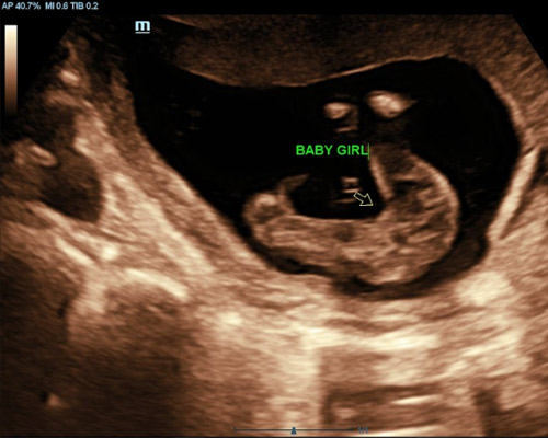 Gender Scan Near Wakefield