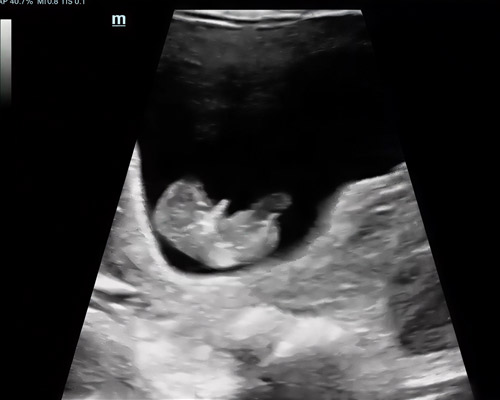 Reassurance Scan in Wakefield