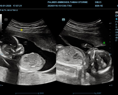 Twin Pregnancy Gender Scan