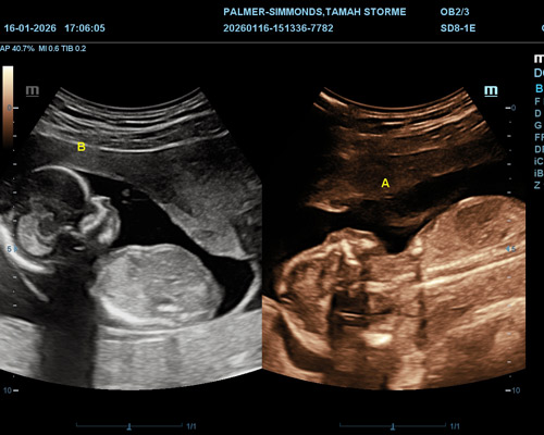 Twin Pregnancy Gender Scan Near Wakefield