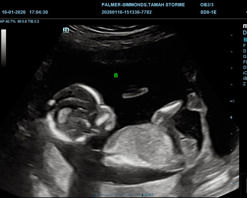 Twin Pregnancy Gender Scan Near Wakefield