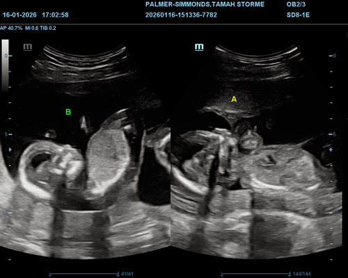 Twin Pregnancy Gender Scan Near Worksop